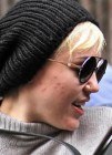 Miley Cyrus tiene problemas de acné